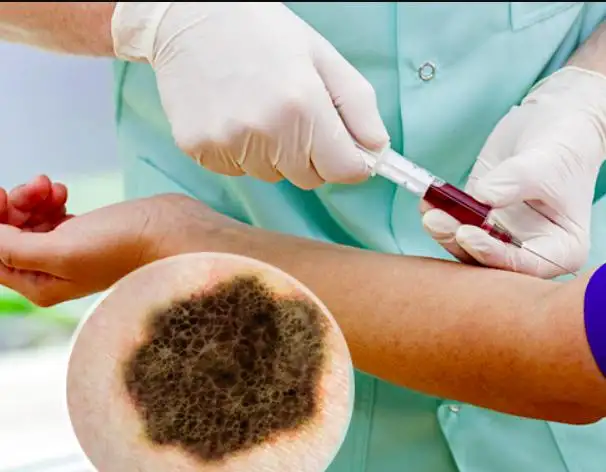 Does Skin Cancer Show Up in Blood Tests? Complete Guide to Detection, Diagnosis, and What You Need to Know