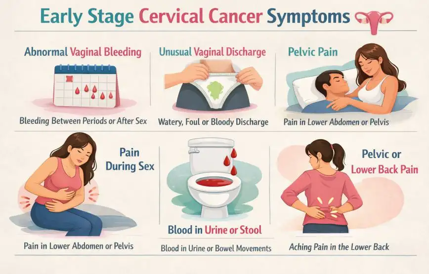 Early Stage Cervical Cancer Symptoms: Signs, Causes, Diagnosis, and Treatment You Should Know