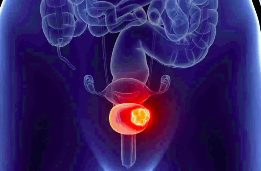 How Fast Does Bladder Cancer Grow: Understanding Progression, Symptoms, and Treatment