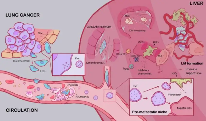 Lung Cancer Metastasis to Liver: Symptoms, Treatment Options, Prognosis, and Latest Advances