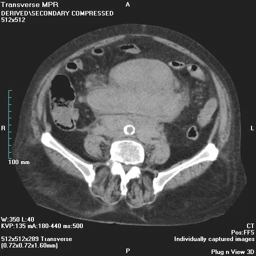 Mesenteric Lymphoma: Understanding This Rare Cancer 2026