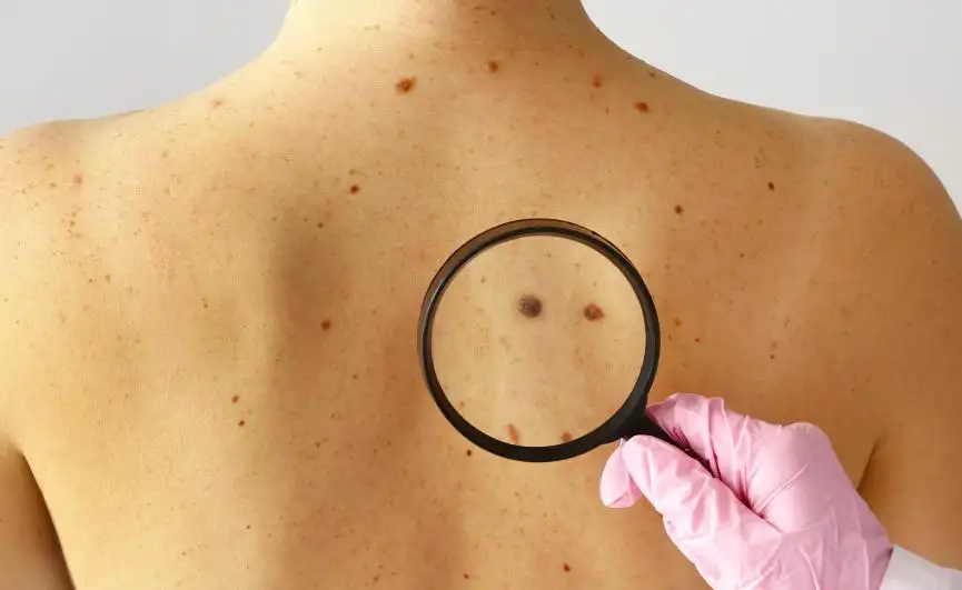 Skin Cancer That Looks Like a Pimple: Symptoms, Causes, Diagnosis, and Treatment Guide