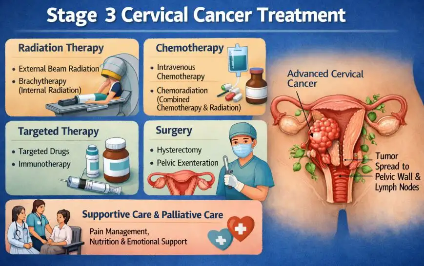 Stage 3 Cervical Cancer Treatment: Comprehensive Guide to Symptoms, Diagnosis, and Modern Treatment Options