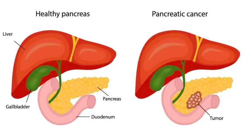 Stage 4 Pancreatic Cancer Spread to Liver: Symptoms, Treatment, Prognosis, and Support